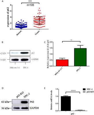 SQSTM1/p62 Promotes Cell Growth and Triggers Autophagy in Papillary Thyroid Cancer by Regulating the AKT/AMPK/mTOR Signaling Pathway